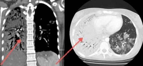 Что видно на КТ грудной клетки. Зачем делают КТ грудной клетки Компьютерную томографию органов грудной клетки проводят людям с подозрением на патологию следующих органов: